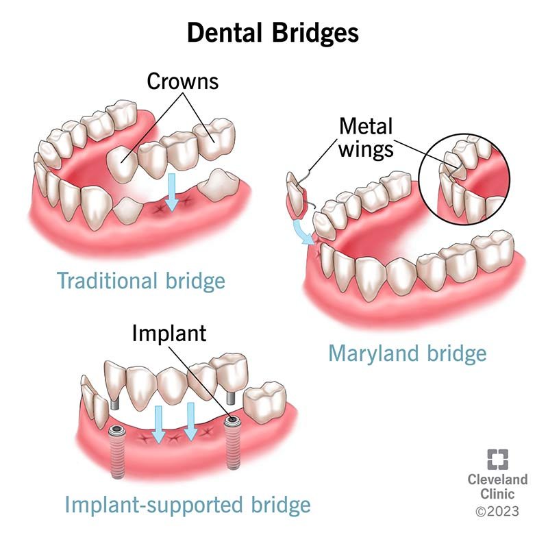 Dentures & Fixed Bridges