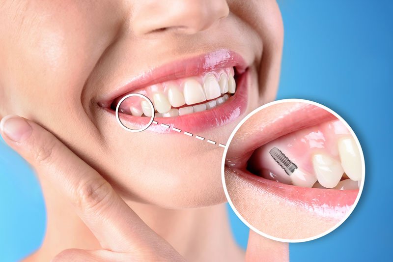 Permanent Dental Implants