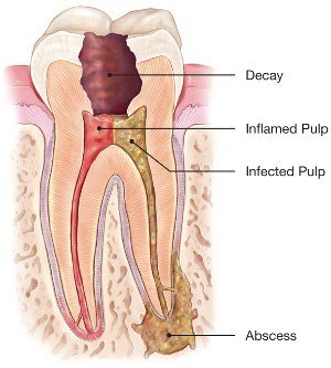 Root Canal Treatment (RCT)