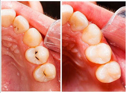 Fillings & Dental Sealants