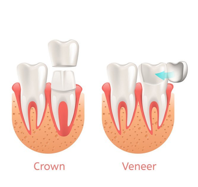 Veneers & Dental Crowns