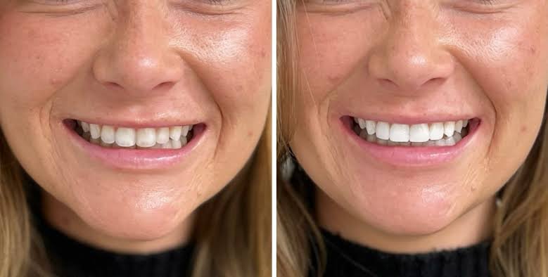 Composite Dental Bonding