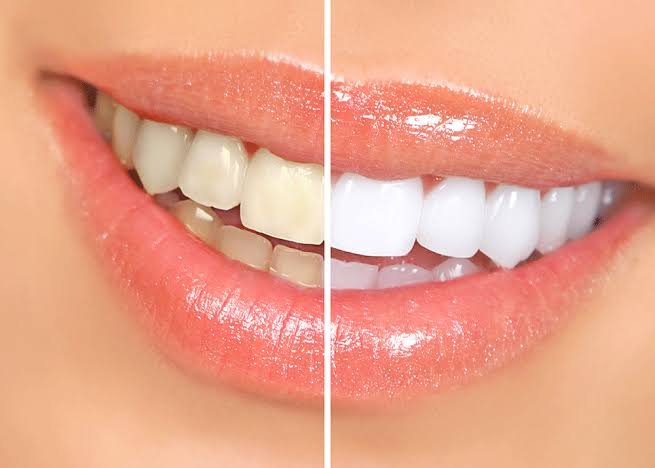 Professional Teeth Whitening
